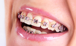 Types of Braces - Atique Orthodontics
